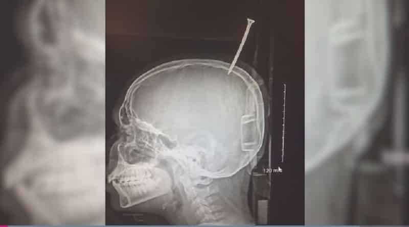 The boy survived the injury to the skull of a huge screw