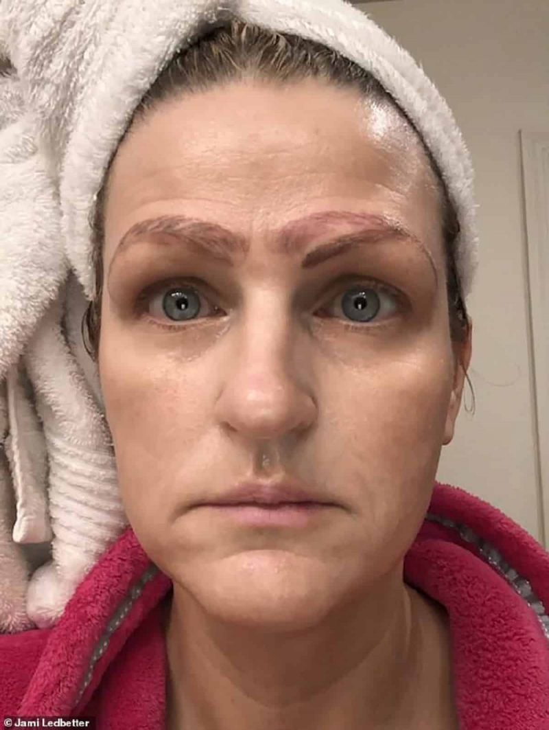 Bad microbleeding: mother of three dumped lover after she had 4 eyebrows