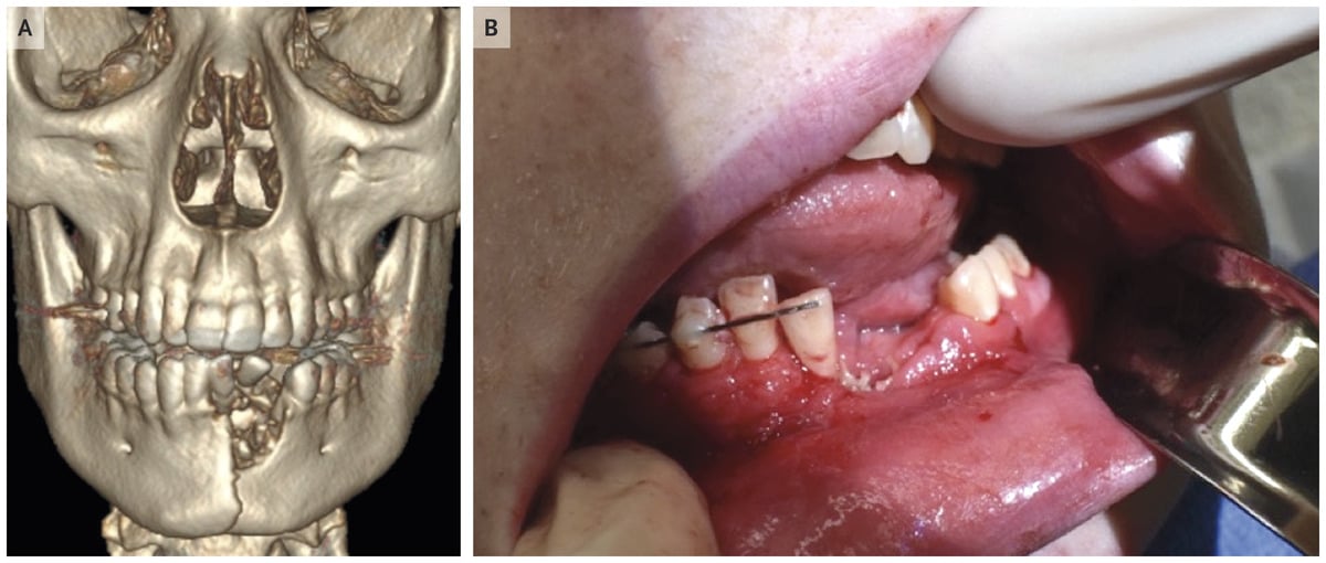 Exploding electronic cigarette broke teen from USA jaw and knocked out teeth