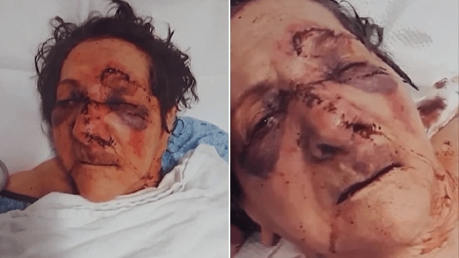 The son of 86-year-old woman posted to social media of a shocking photo to his mother, claiming that she was beaten and broke his nose in a nursing home