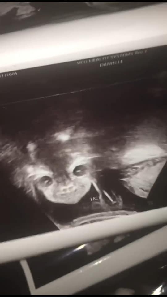 The expectant mother was shocked when I saw the ultrasound «devil’s child» opened his eyes and smiled
