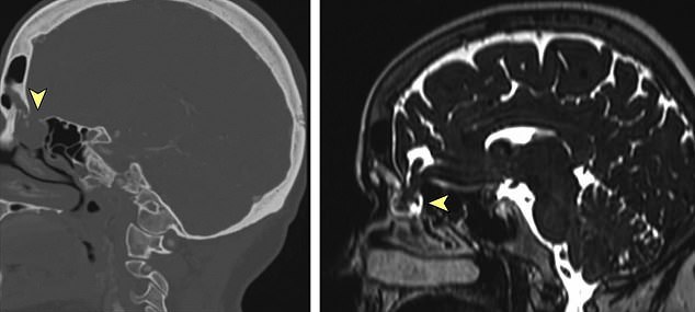 After taking a swab for COVID-19, a woman from Iowa began to leak cerebral fluid from the nose